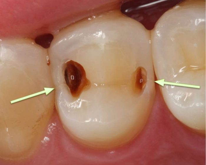 亀裂から始まった虫歯